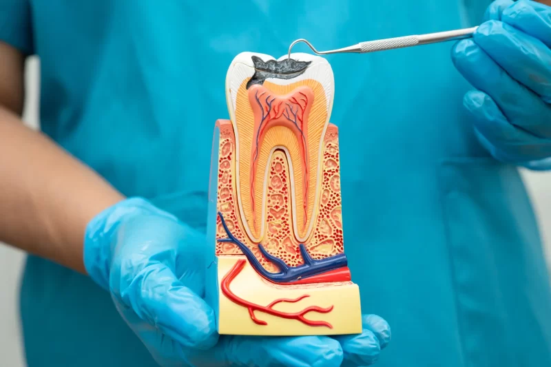 Endodontie-DrDehelean_001 - Clinica Stomatologica Dr Dehelean Bucuresti