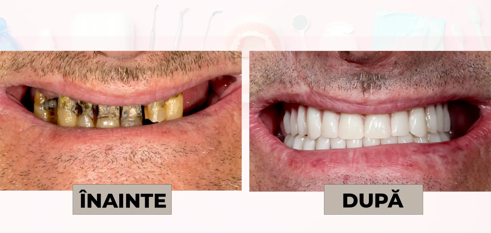 Cazuri_clinice_DrDehelean_001 - Clinica Stomatologica Dr Dehelean Bucuresti Before and after dental makeover: left shows decayed, yellowed teeth; right shows clean, white teeth.