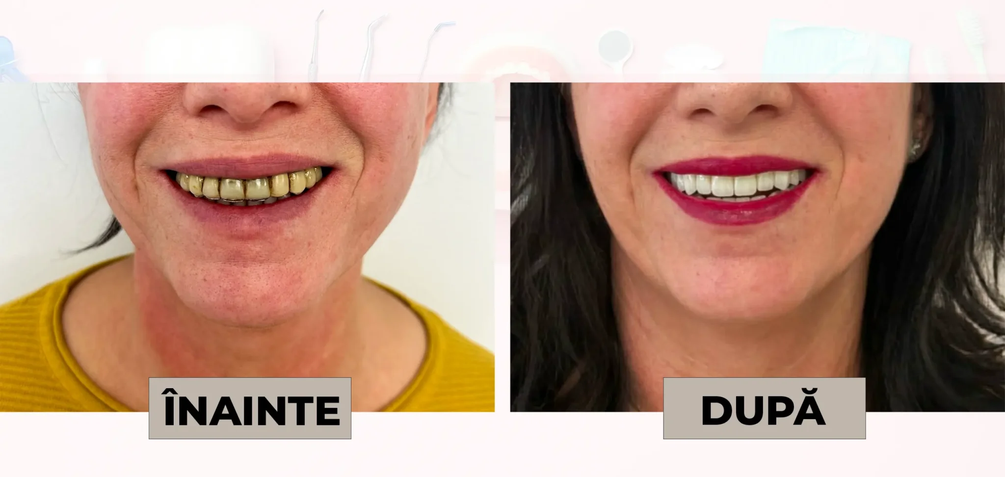 Cazuri_clinice_DrDehelean_002 - Clinica Stomatologica Dr Dehelean Bucuresti Two side-by-side photos showing a dental transformation: left labeled 'ÎNAINTE' with yellowed teeth, right labeled 'DUPĂ' with bright white teeth and red lipstick.