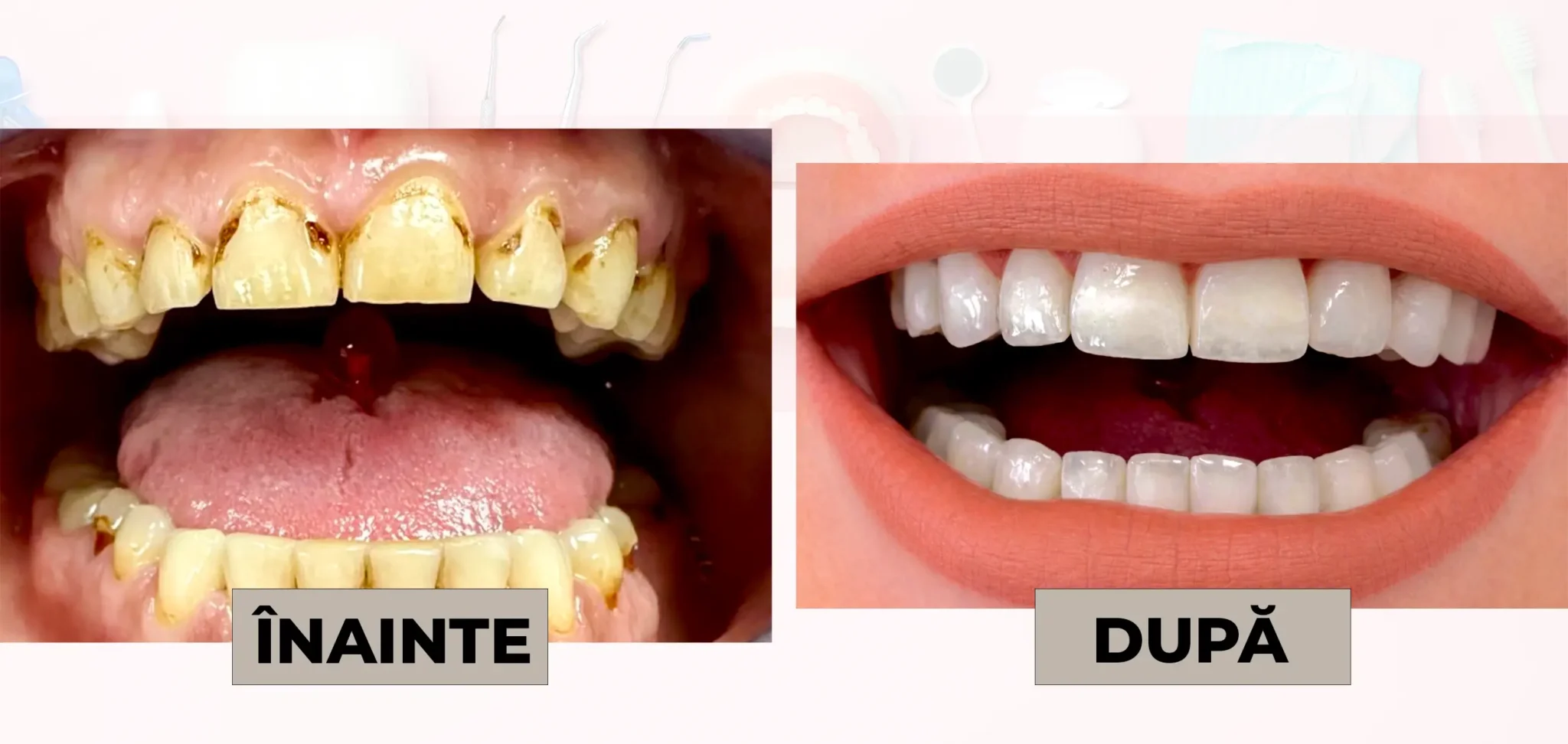 Cazuri_clinice_DrDehelean_003 - Clinica Stomatologica Dr Dehelean Bucuresti Before and after dental restoration: left side shows severely decayed, yellowed teeth with gum issues (labeled ÎNAINTE); right side shows a straight, white smile after treatment (labeled DUPĂ).