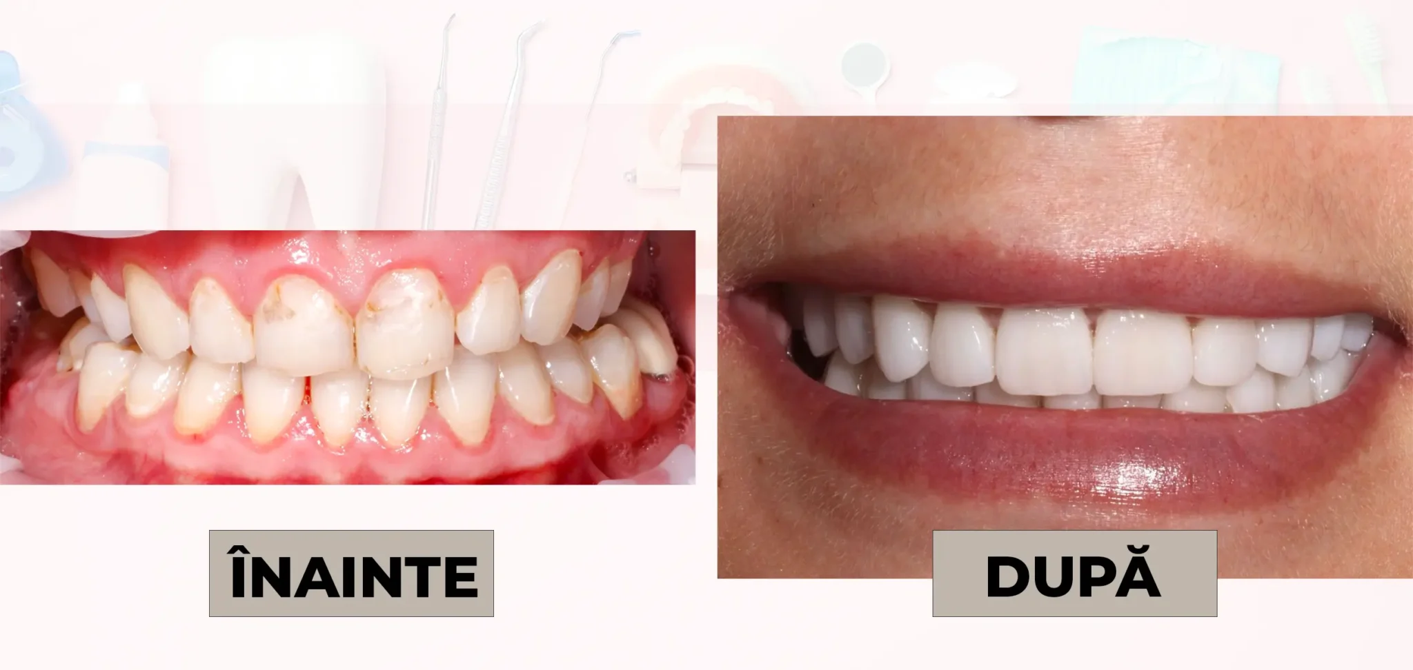 Cazuri_clinice_DrDehelean_004 - Clinica Stomatologica Dr Dehelean Bucuresti Before and after dental treatment: left image shows inflamed gums and stained teeth; right image shows a straight, white smile.