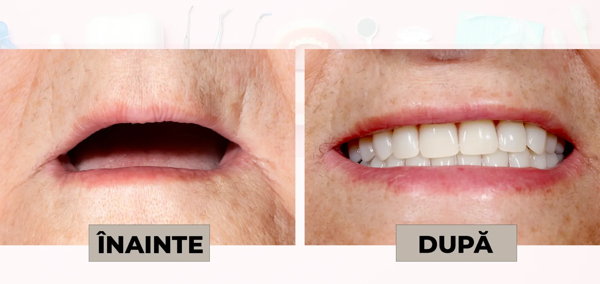 Cazuri_clinice_DrDehelean_005 - Clinica Stomatologica Dr Dehelean Bucuresti Before and after dental treatment: left panel shows an open mouth with missing teeth, right panel shows a full set of white teeth with a smile; labels read 'ÎNAINTE' and 'DUPĂ'.