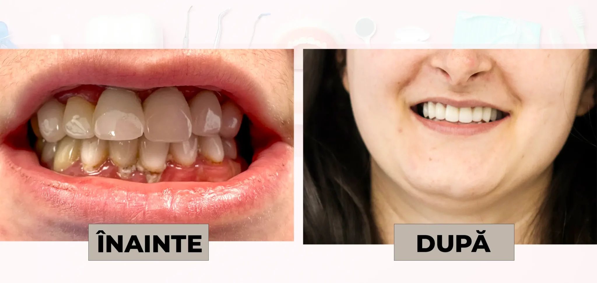 Cazuri_clinice_DrDehelean_006 - Clinica Stomatologica Dr Dehelean Bucuresti Split-screen showing a dental whitening transformation: left side with stained, yellowed teeth labeled 'ÎNAINTE' (before), right side with a bright white smile labeled 'DUPĂ' (after).