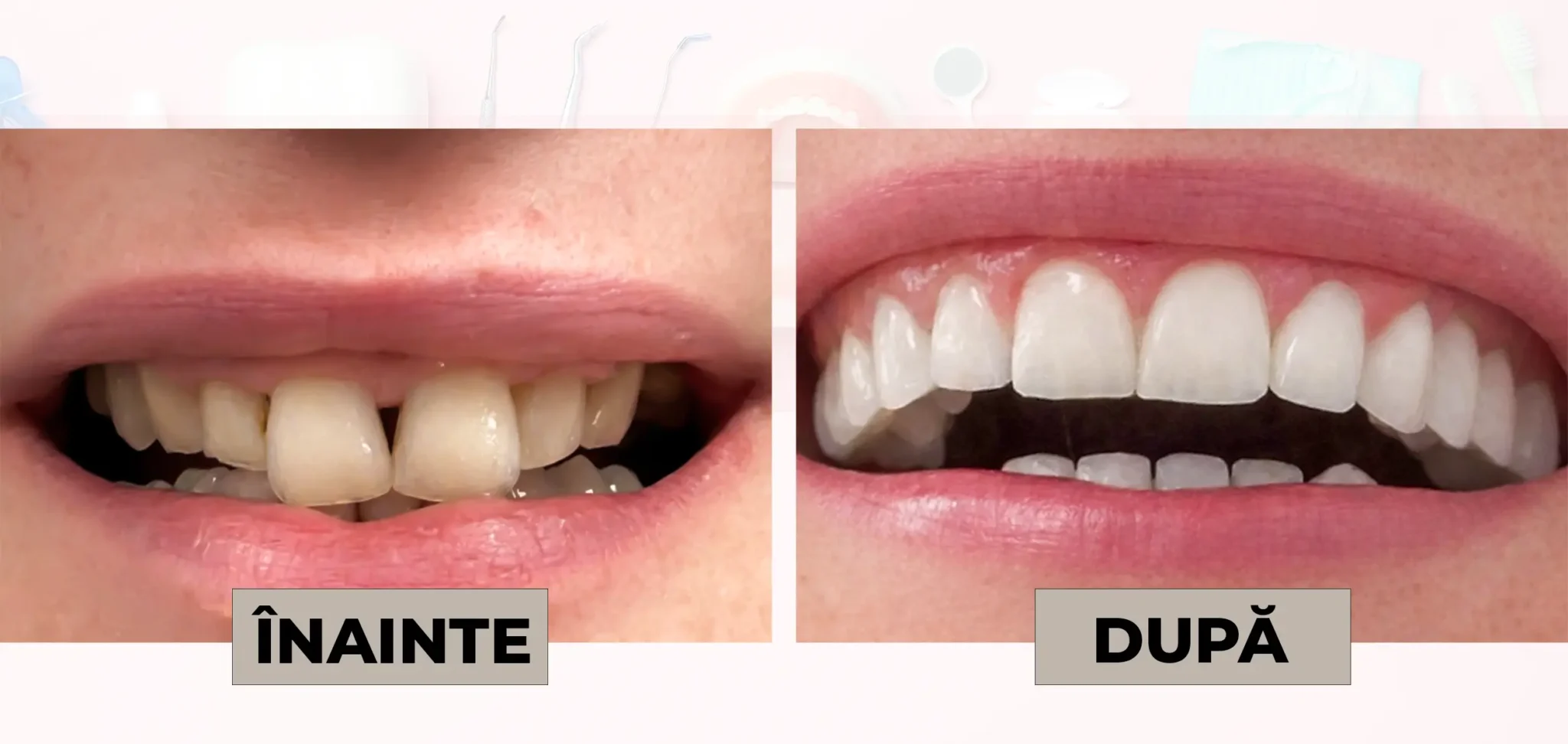 Cazuri_clinice_DrDehelean_007 - Clinica Stomatologica Dr Dehelean Bucuresti Before (left) and after (right) dental whitening: yellowish teeth vs. noticeably whiter teeth in a close-up smile, with Romanian labels 'INainte' and 'DUPA'.
