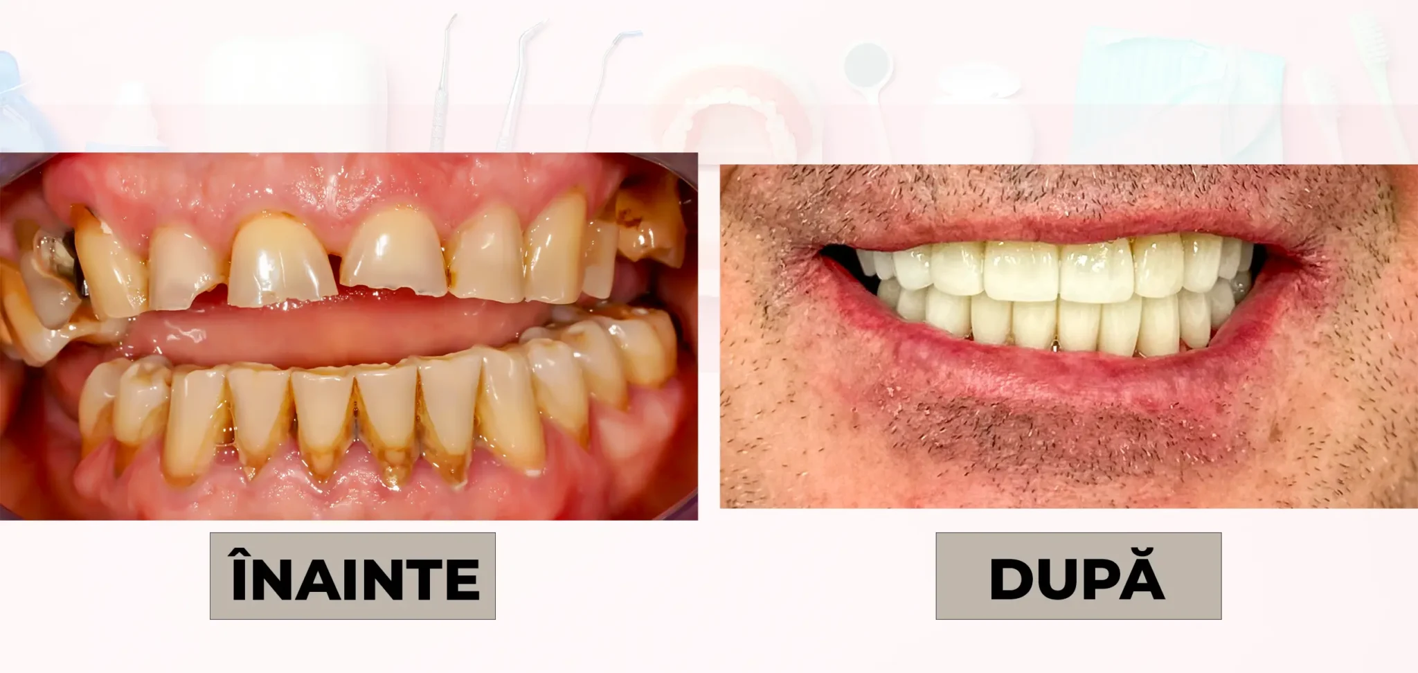Cazuri_clinice_DrDehelean_009 - Clinica Stomatologica Dr Dehelean Bucuresti Left image shows teeth before treatment with decay and crowding; right image shows teeth after treatment with a straight, whiter smile (labelled ÎNAINTE and DUPĂ).