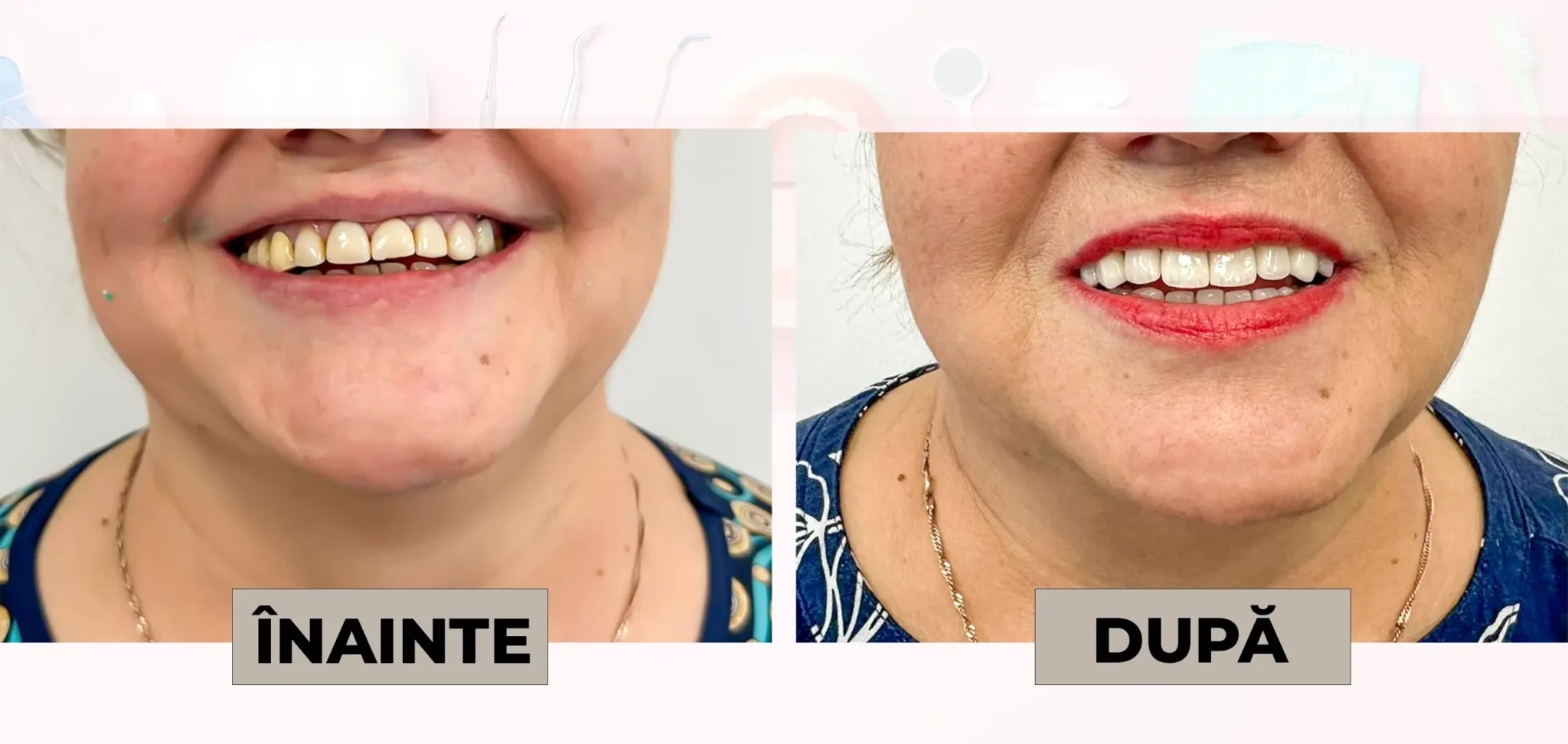 Cazuri_clinice_DrDehelean_010 - Clinica Stomatologica Dr Dehelean Bucuresti Side-by-side photos of a woman's smile before and after dental treatment: left with yellowed teeth and gaps, right with bright white, aligned teeth and red lipstick