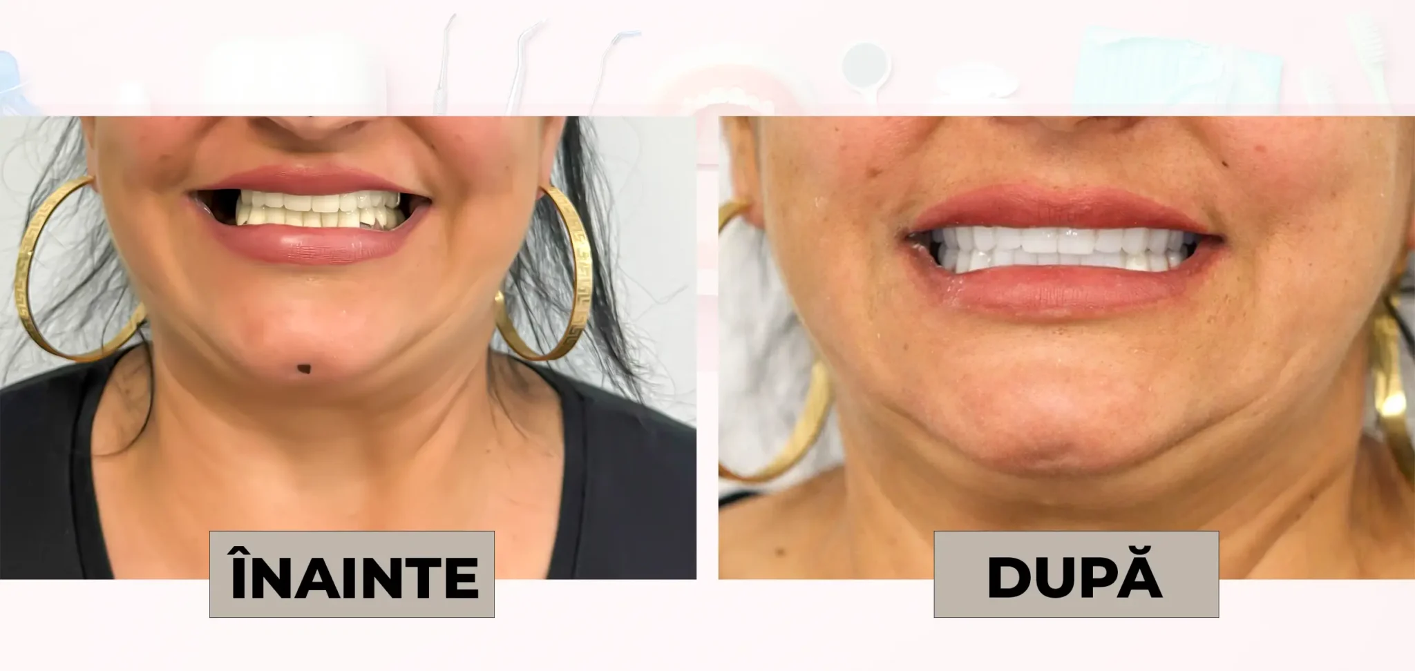Cazuri_clinice_DrDehelean_011 - Clinica Stomatologica Dr Dehelean Bucuresti Before-and-after comparison of a woman's smile: left image shows teeth before treatment, right image shows brighter teeth after treatment; labels read INAINTE and DUPĂ.