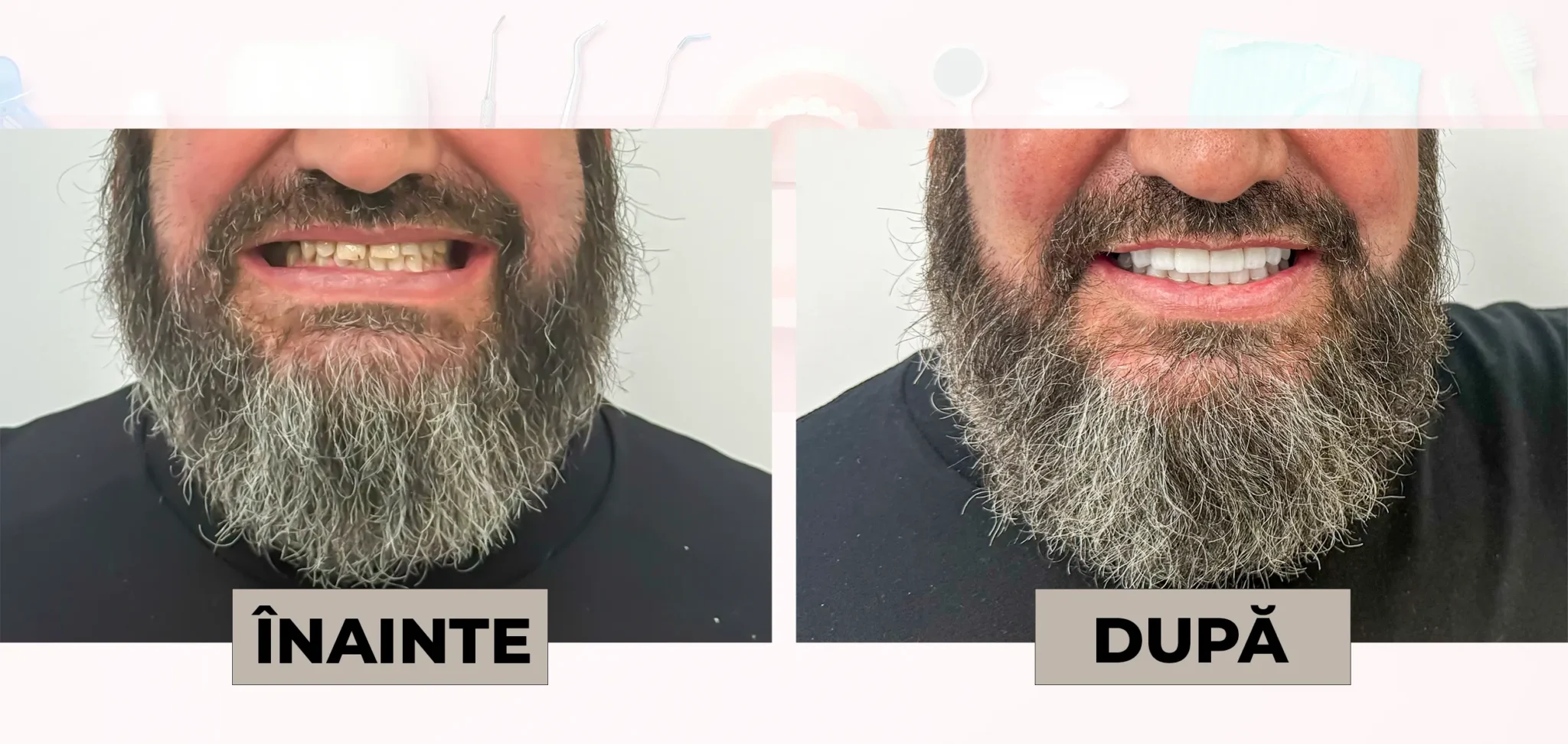 Cazuri_clinice_DrDehelean_012 - Clinica Stomatologica Dr Dehelean Bucuresti Before and after comparison: bearded man with yellowed teeth on the left and whitened teeth on the right (labels 'ÎNAINTE' and 'DUPĂ').