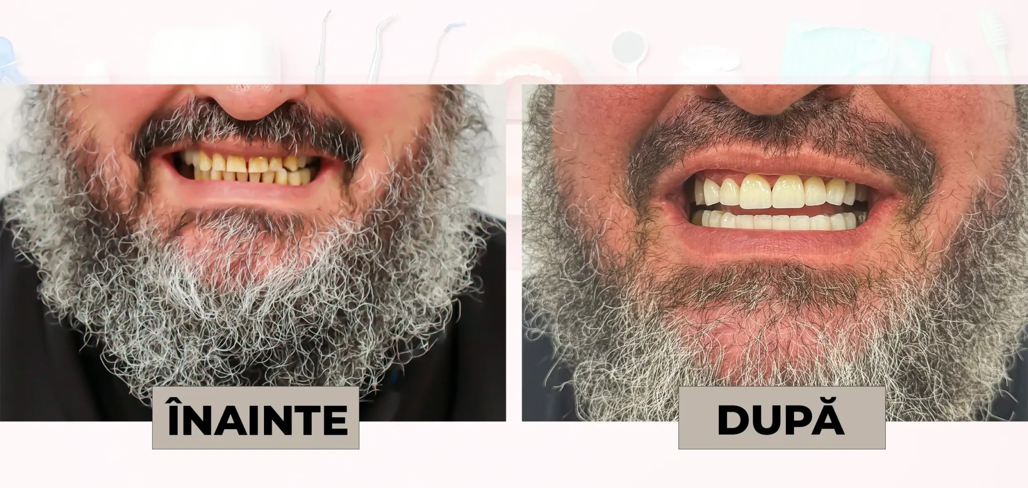 Cazuri_clinice_DrDehelean_013 - Clinica Stomatologica Dr Dehelean Bucuresti Before-and-after comparison of a bearded man's teeth whitening (left: ÎNAINTE, right: DUPĂ) with noticeably whiter teeth after treatment.
