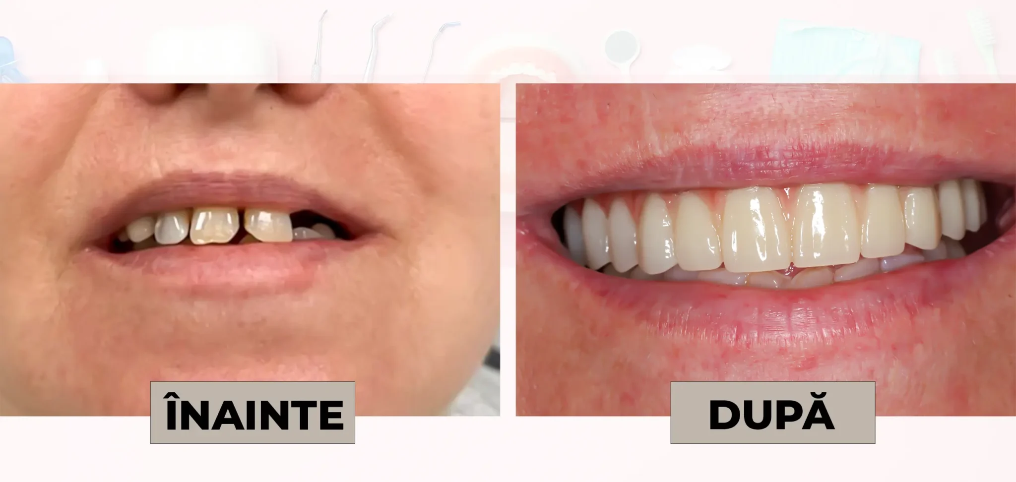 Cazuri_clinice_DrDehelean_016 - Clinica Stomatologica Dr Dehelean Bucuresti Before and after dental treatment: misaligned, discolored teeth on the left; straight, whiter teeth after on the right.