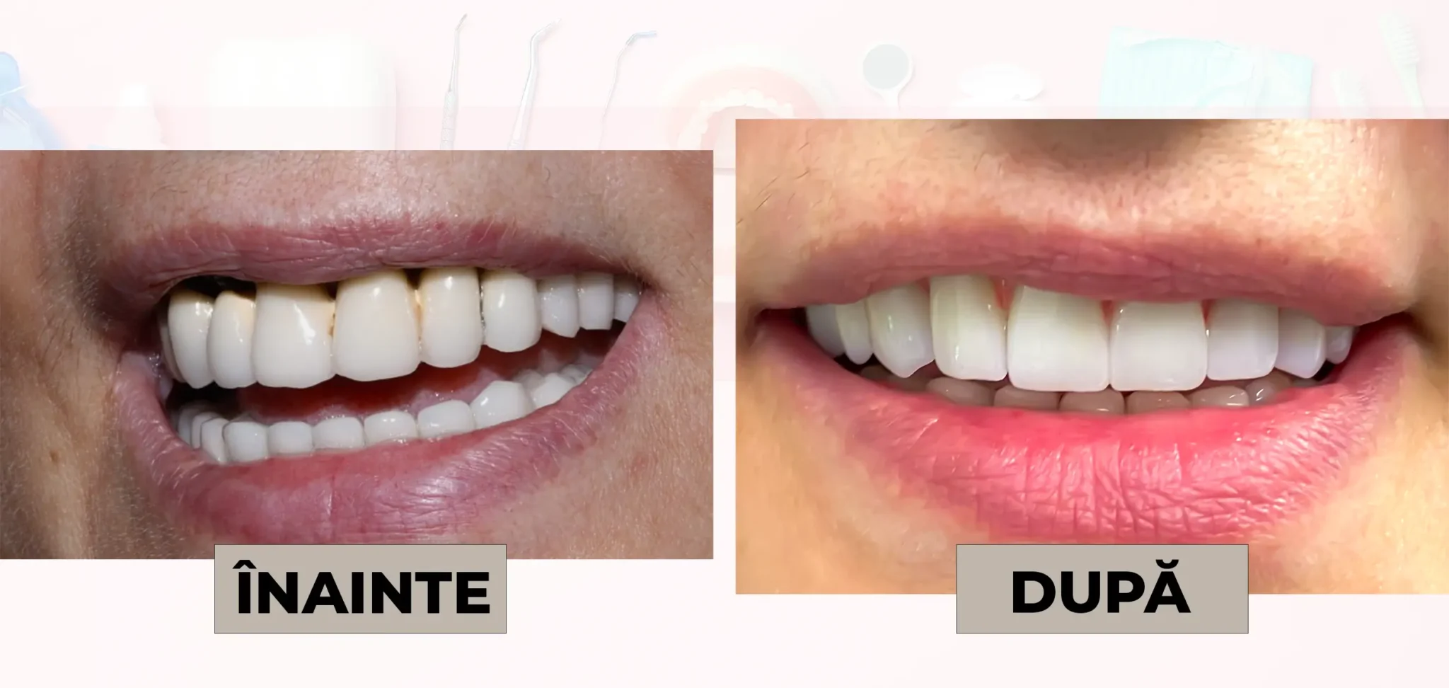 Cazuri_clinice_DrDehelean_017 - Clinica Stomatologica Dr Dehelean Bucuresti Left: before whitening with yellowed teeth; right: after whitening with brighter, whiter teeth.