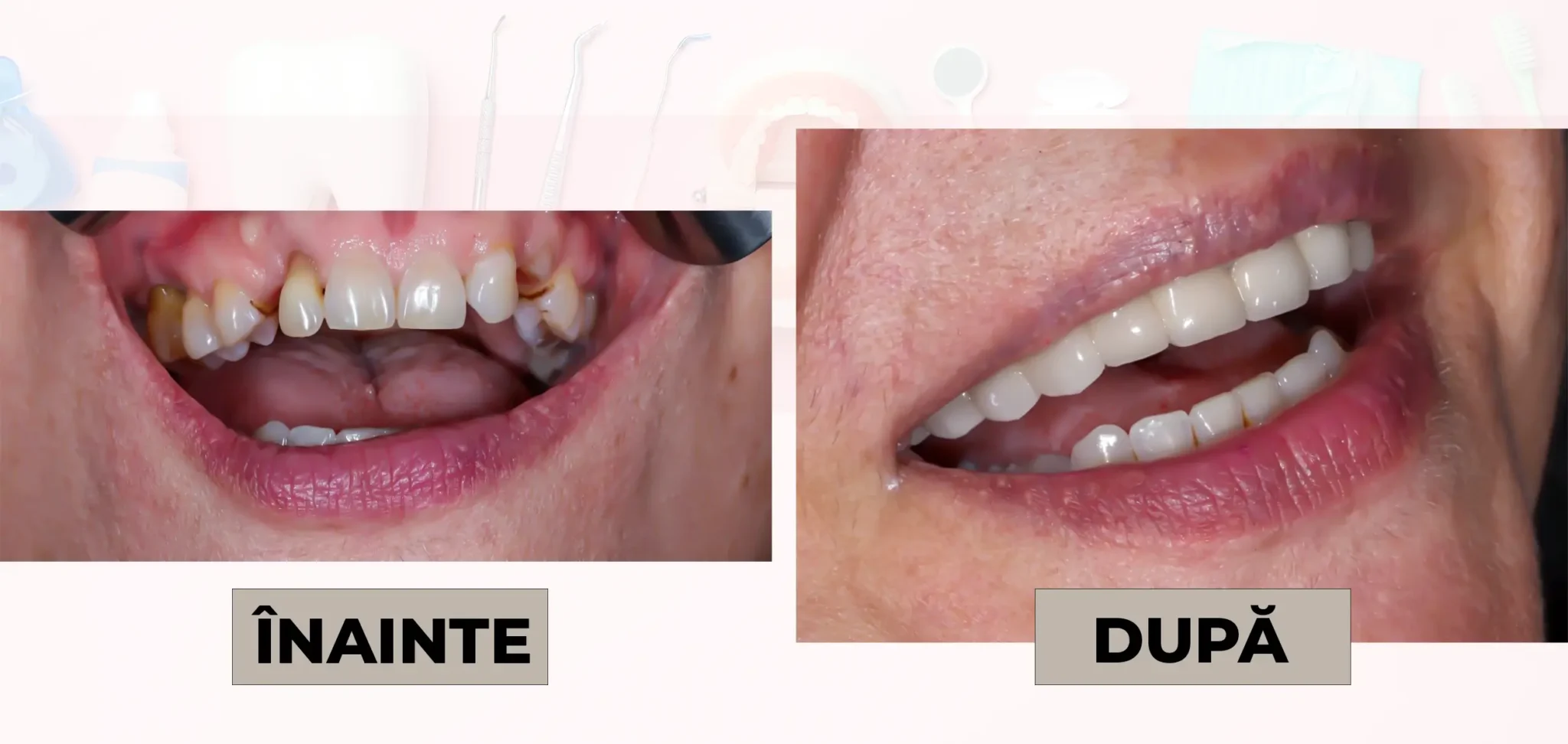 Cazuri_clinice_DrDehelean_018 - Clinica Stomatologica Dr Dehelean Bucuresti Before and after dental treatment: left image shows decayed, crooked teeth; right image shows whiter, straight teeth after restoration.