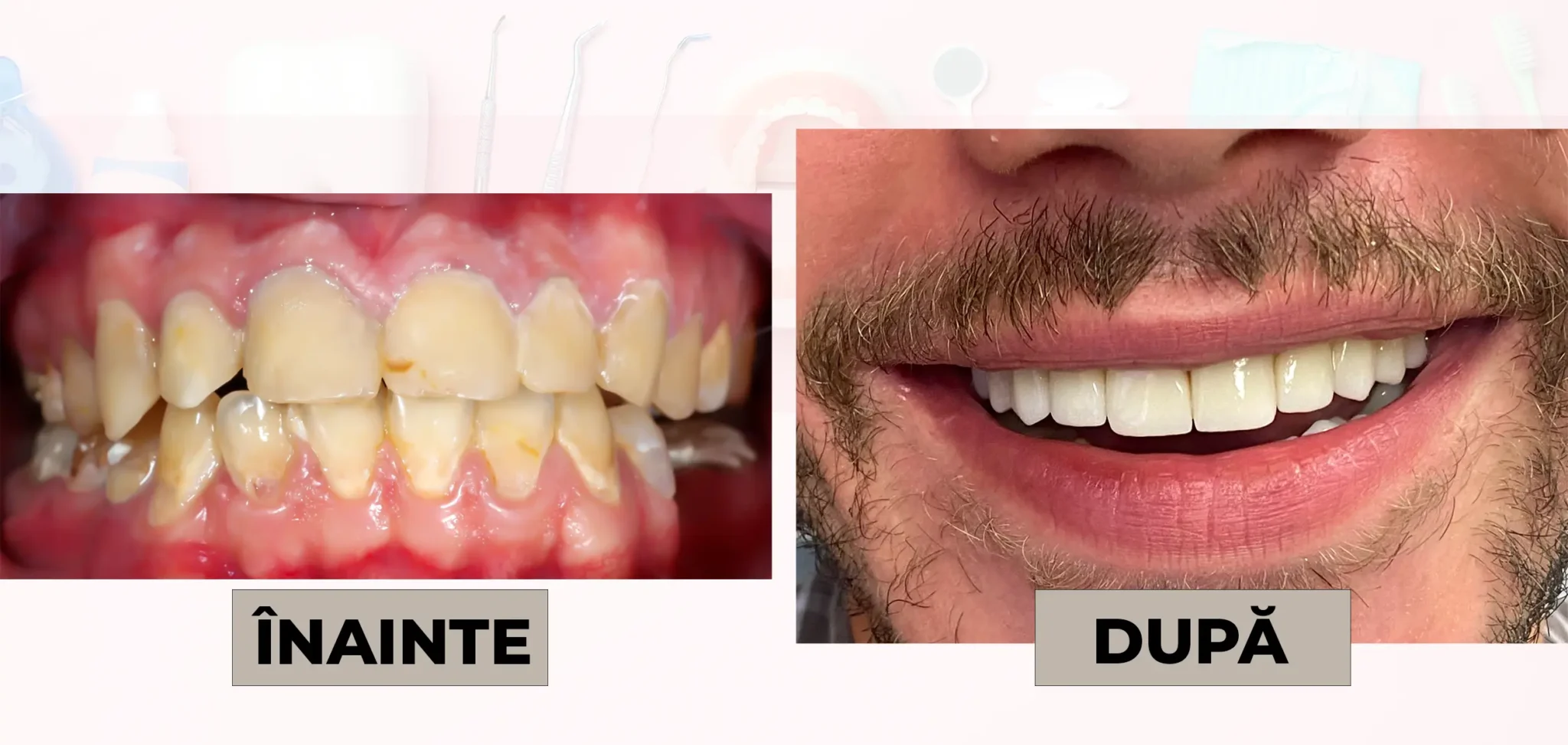 Cazuri_clinice_DrDehelean_019 - Clinica Stomatologica Dr Dehelean Bucuresti Before (left) shows yellowed, stained teeth and inflamed gums; after (right) shows a bright, white smile following treatment.