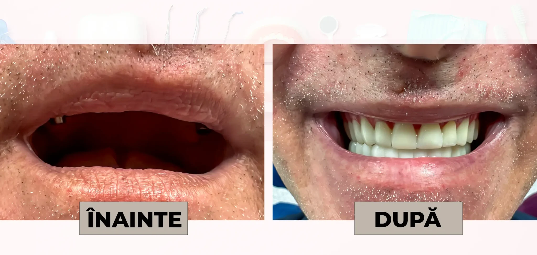 Cazuri_clinice_DrDehelean_020 - Clinica Stomatologica Dr Dehelean Bucuresti Before and after dental implant restoration: left image shows a missing tooth with an open mouth; right image shows a full smile with new implants and artificial teeth.