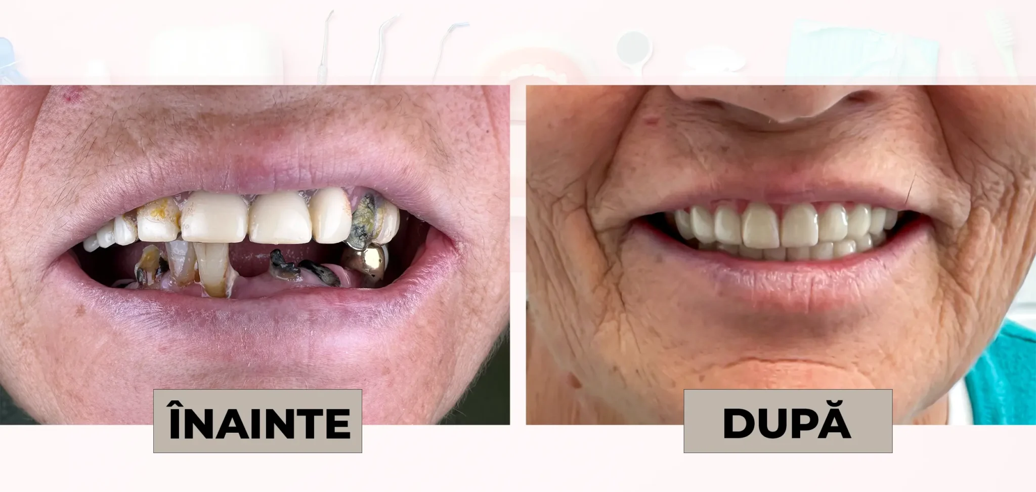 Cazuri_clinice_DrDehelean_021 - Clinica Stomatologica Dr Dehelean Bucuresti Before and after dental restoration: left shows severe decay and missing teeth, right shows a full set of new teeth with a healed smile