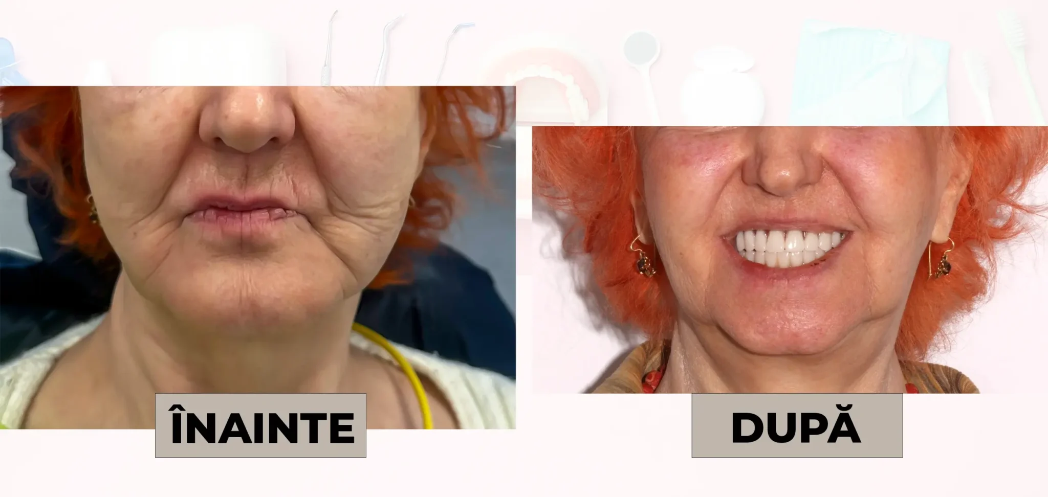 Cazuri_clinice_DrDehelean_023 - Clinica Stomatologica Dr Dehelean Bucuresti Before-and-after comparison of a woman's face: left shows wrinkles around mouth with sparse teeth; right shows a bright, wide smile after dental treatment (labeled ÎNAINTE and DUPĂ).