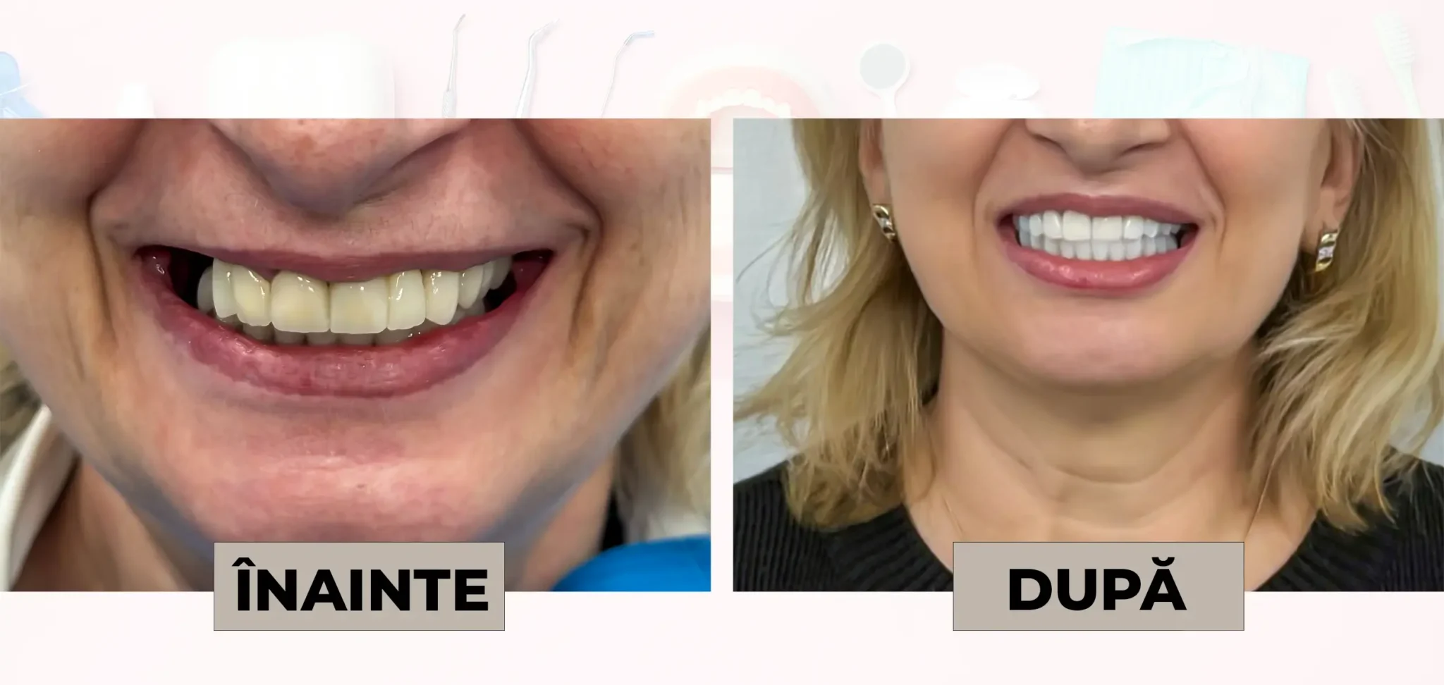 Cazuri_clinice_DrDehelean_024 - Clinica Stomatologica Dr Dehelean Bucuresti Before and after dental smile makeover: left shows stained, uneven teeth; right shows bright, straight teeth labeled 'ÎNAINTE' and 'DUPĂ' (before/after).