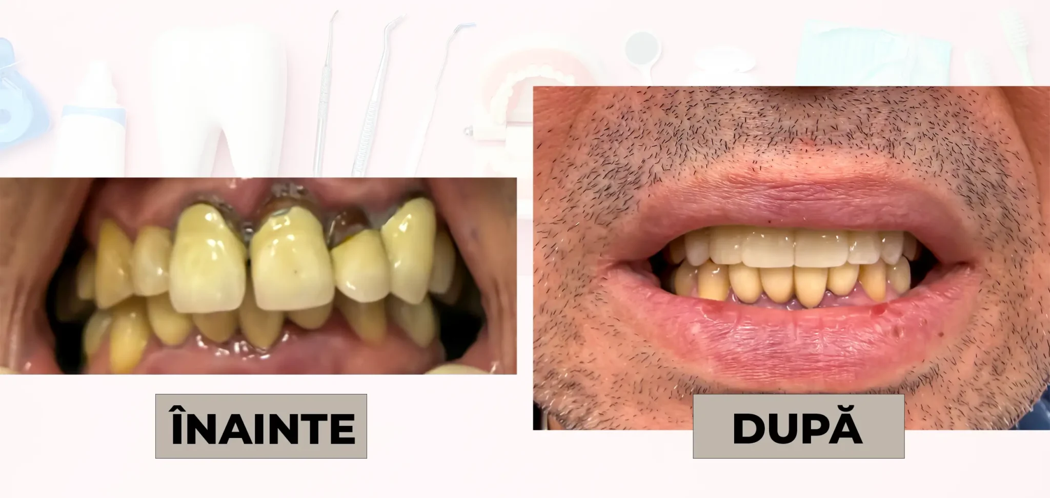 Cazuri_clinice_DrDehelean_025 - Clinica Stomatologica Dr Dehelean Bucuresti Before and after dental treatment: crowded yellow teeth on the left and straight white teeth on the right.