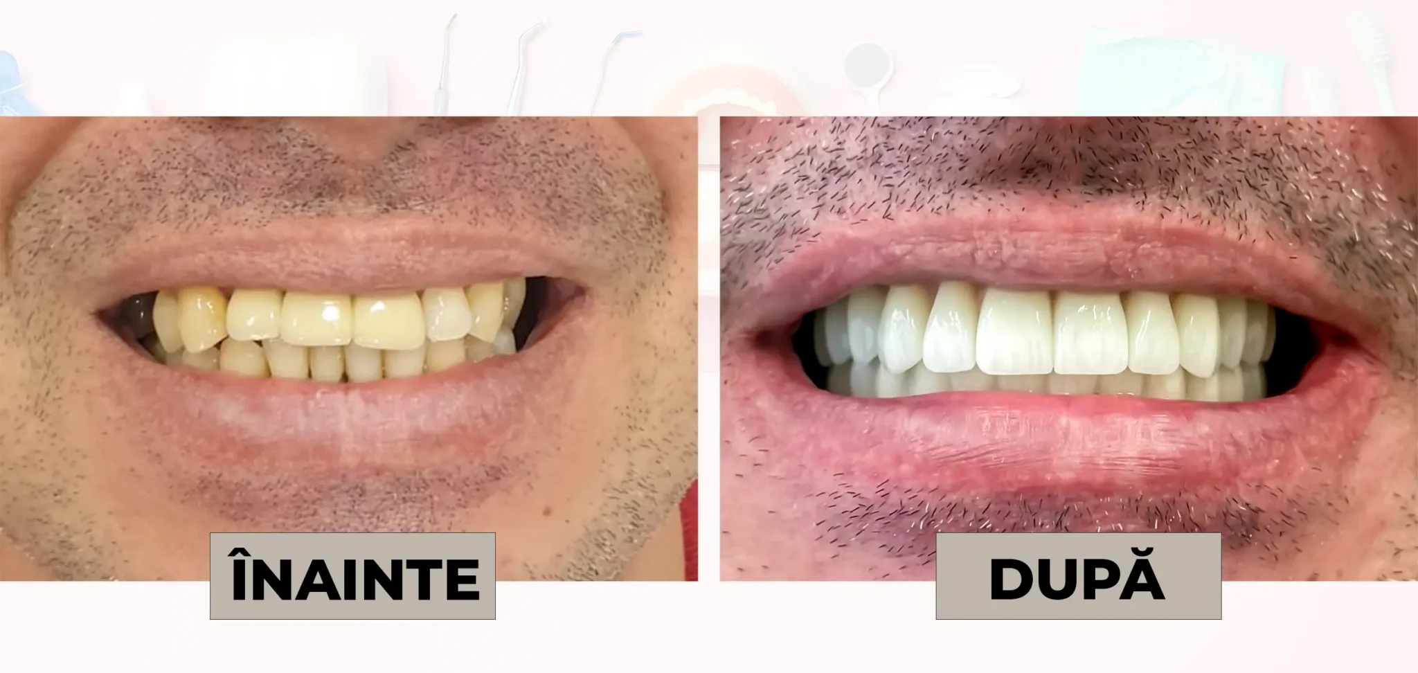 Cazuri_clinice_DrDehelean_026 - Clinica Stomatologica Dr Dehelean Bucuresti Before-and-after dental whitening: left shows yellowed teeth, right shows noticeably whiter teeth after treatment.