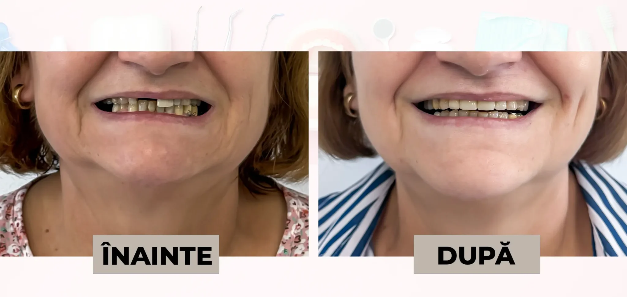 Cazuri_clinice_DrDehelean_027 - Clinica Stomatologica Dr Dehelean Bucuresti