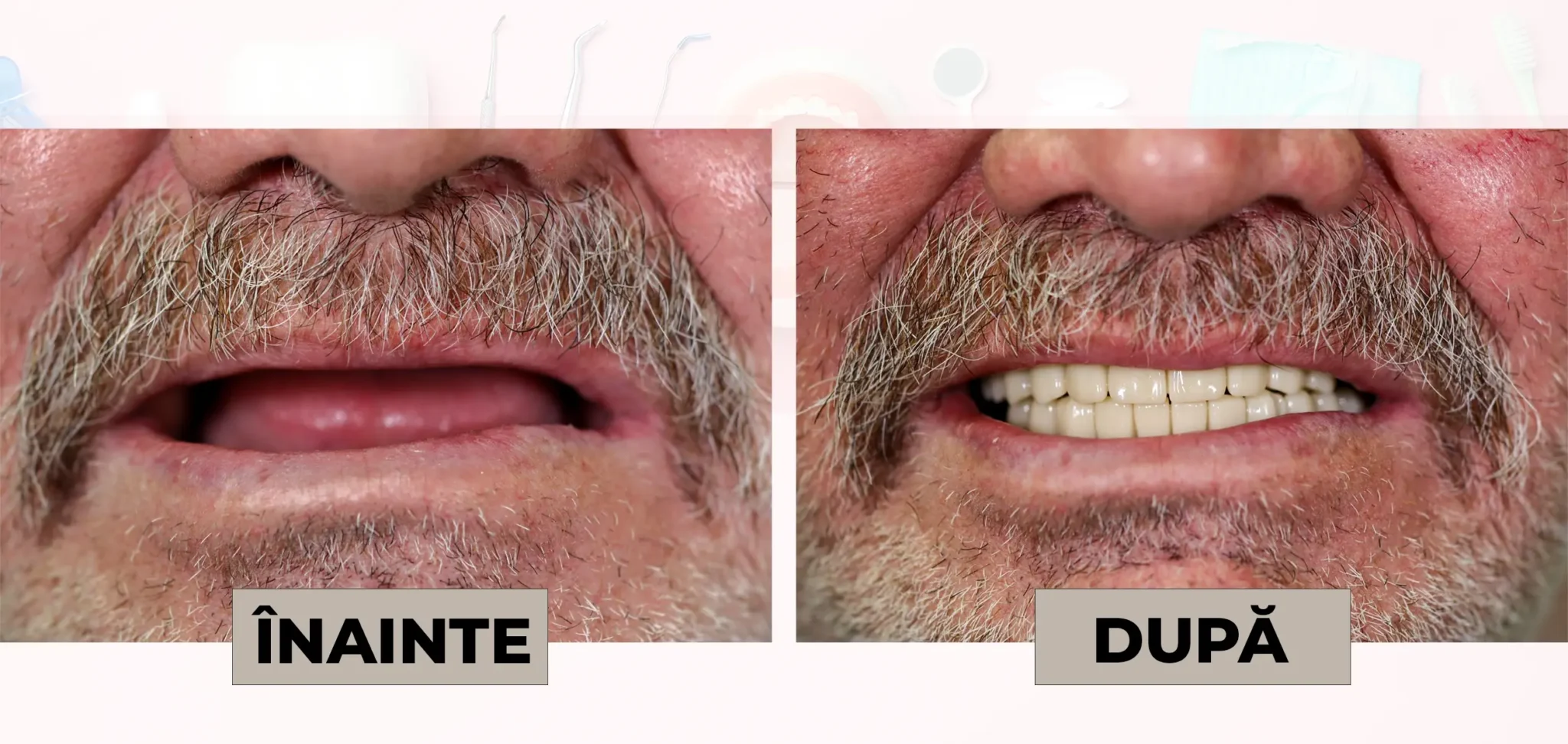 Cazuri_clinice_DrDehelean_028 - Clinica Stomatologica Dr Dehelean Bucuresti Side-by-side close-up of an older man's mouth: left 'ÎNAINTE' shows missing/hidden teeth, right 'DUPĂ' shows a full set of white teeth after dental treatment