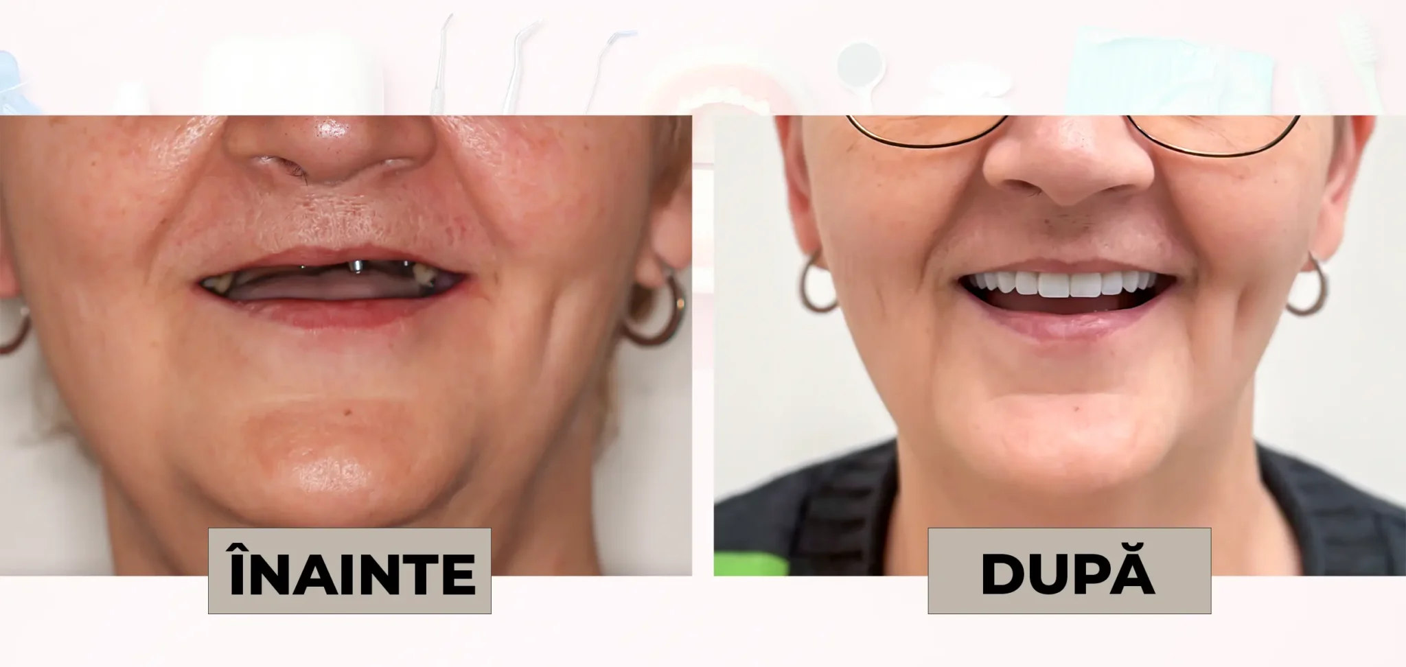 Cazuri_clinice_DrDehelean_029 - Clinica Stomatologica Dr Dehelean Bucuresti Before-and-after dental transformation: left image shows uneven smile with missing teeth; right image shows a full, bright smile after treatment.