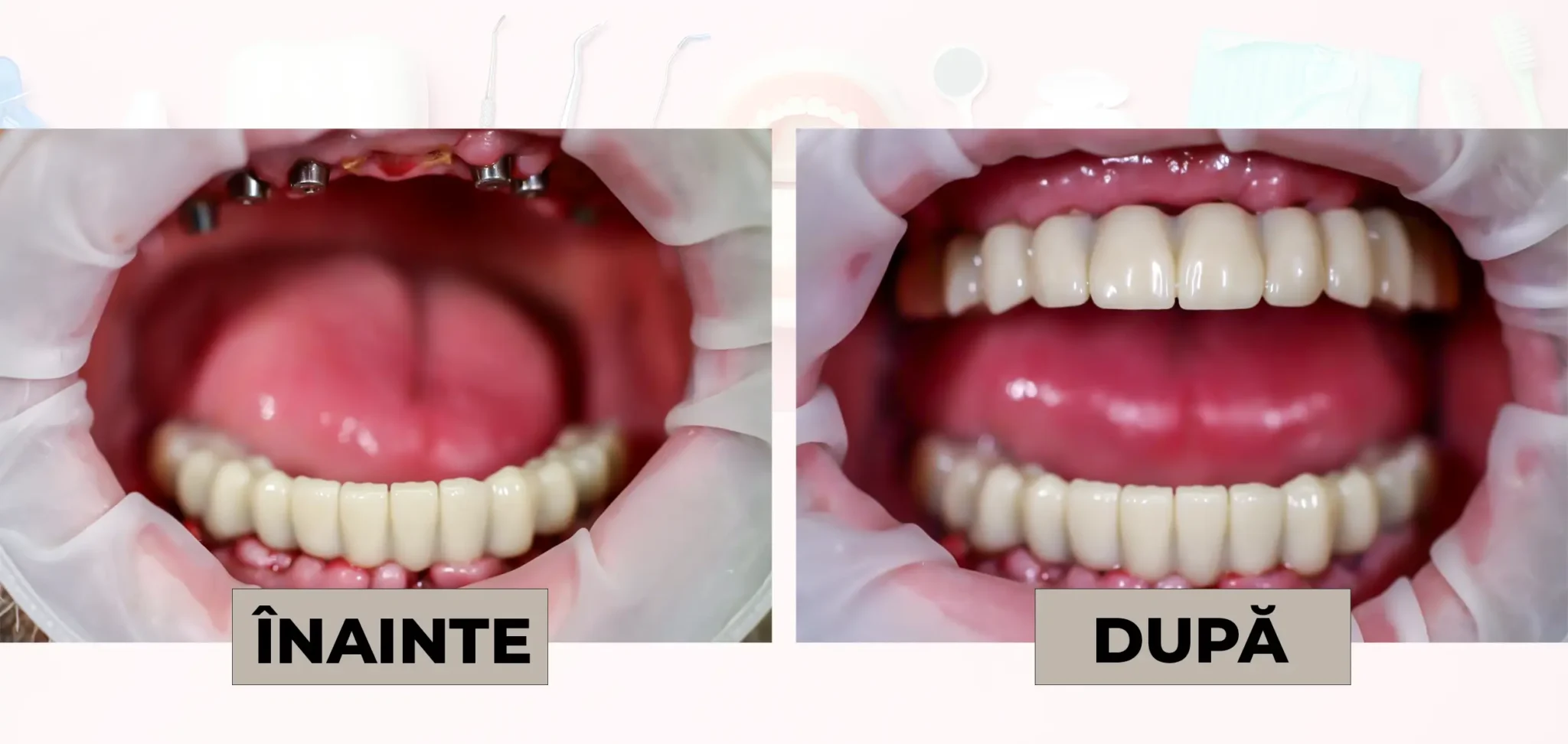 Cazuri_clinice_DrDehelean_030 - Clinica Stomatologica Dr Dehelean Bucuresti În stânga: înainte, cu implanturi dentare vizibile în arcada superioară. În dreapta: după, cu dinți superiori restaurați complet.
