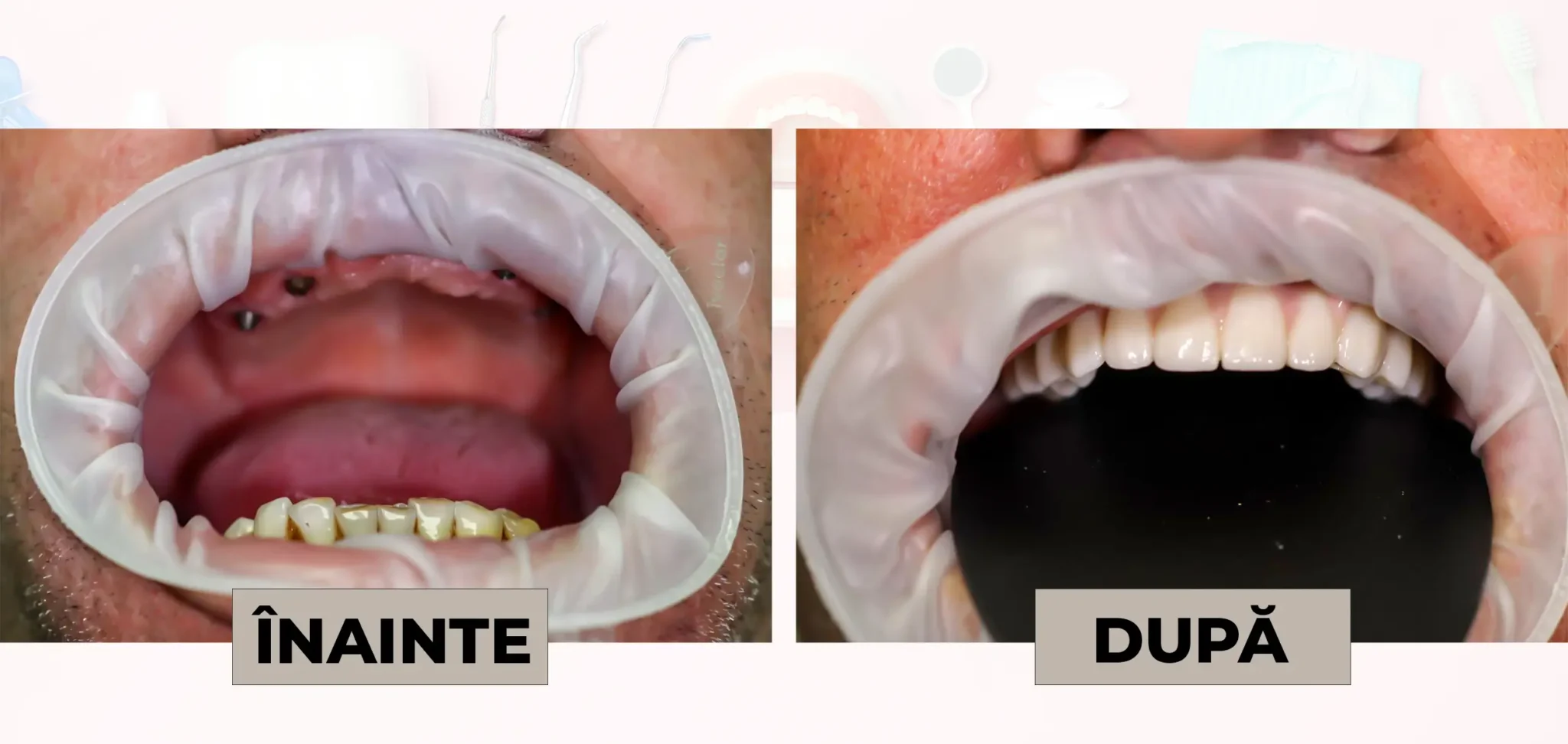 Cazuri_clinice_DrDehelean_031 - Clinica Stomatologica Dr Dehelean Bucuresti Before and after dental restoration: left shows missing teeth and gum issues; right shows a full set of upper teeth with whitening or crowns.