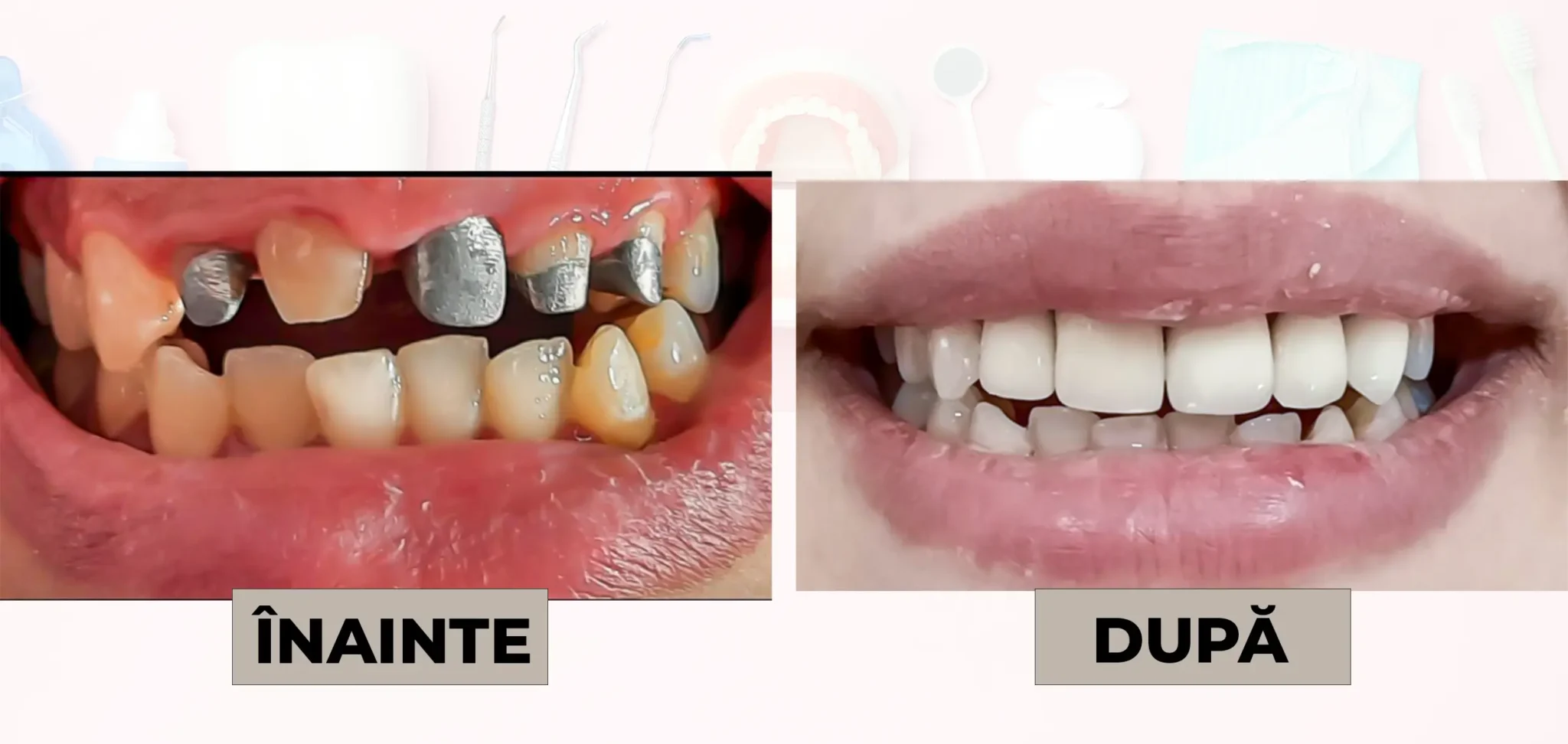 Cazuri_clinice_DrDehelean_032 - Clinica Stomatologica Dr Dehelean Bucuresti ÎNAINTE: dinți deteriorați cu coroane metalice și spații, înainte de tratament dental; DUPĂ: dinți albi, aliniați, după tratament restaurativ.