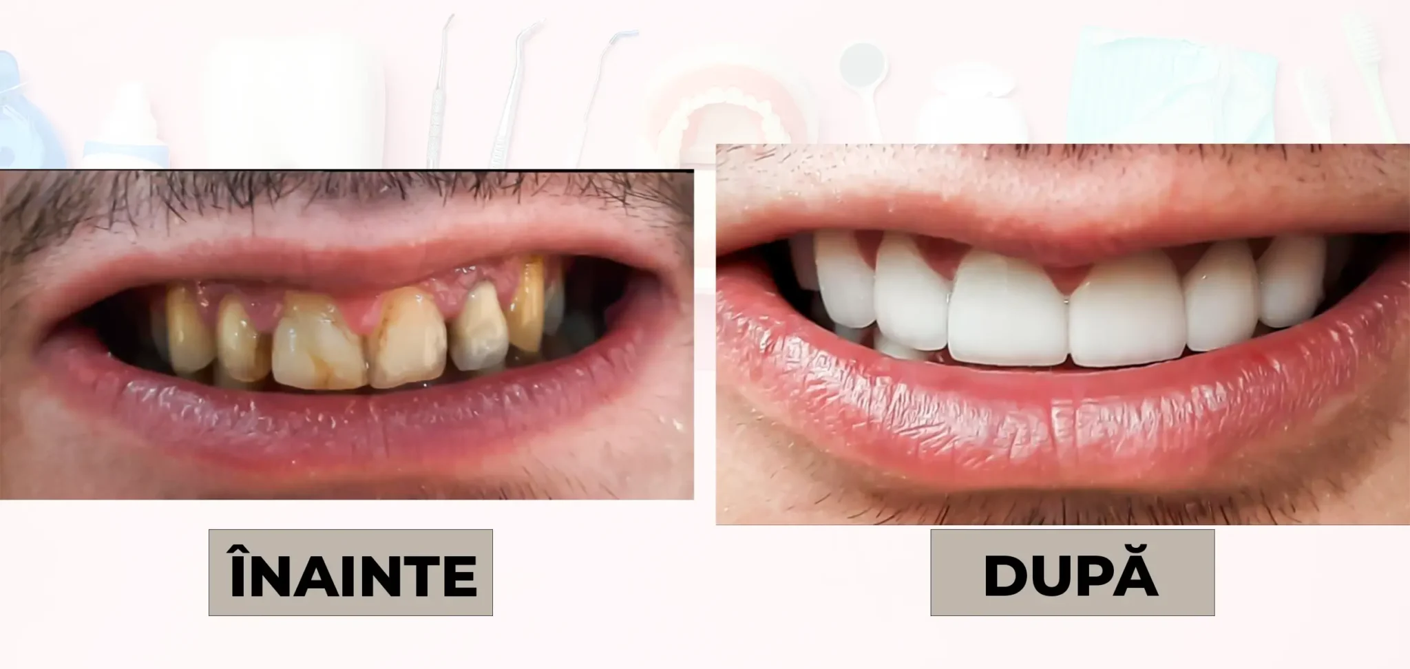 Cazuri_clinice_DrDehelean_034 - Clinica Stomatologica Dr Dehelean Bucuresti Before vs after dental whitening: left image shows yellowed teeth, right image shows bright white teeth in a smile.