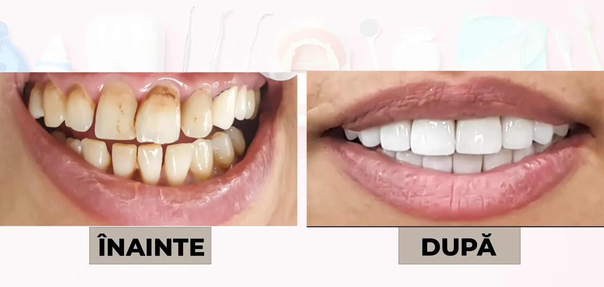 Cazuri_clinice_DrDehelean_035 - Clinica Stomatologica Dr Dehelean Bucuresti Fotografie cu pereche de zâmbete: înainte pe stânga, dinți galbeni și patați; după pe dreapta, dinți albi și curați.