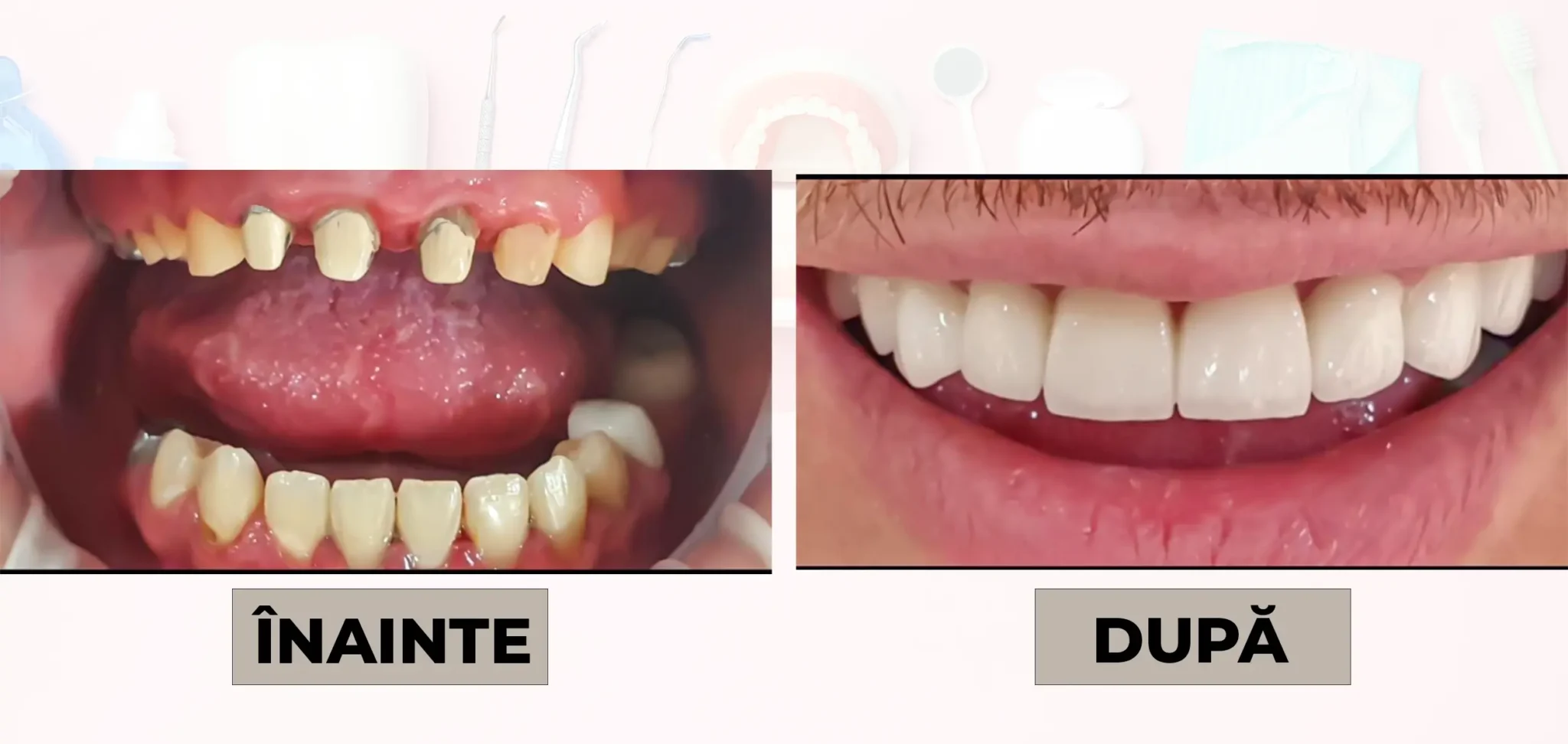 Cazuri_clinice_DrDehelean_036 - Clinica Stomatologica Dr Dehelean Bucuresti Before and after dental implant treatment showing repaired teeth and improved smile (left: before, right: after).