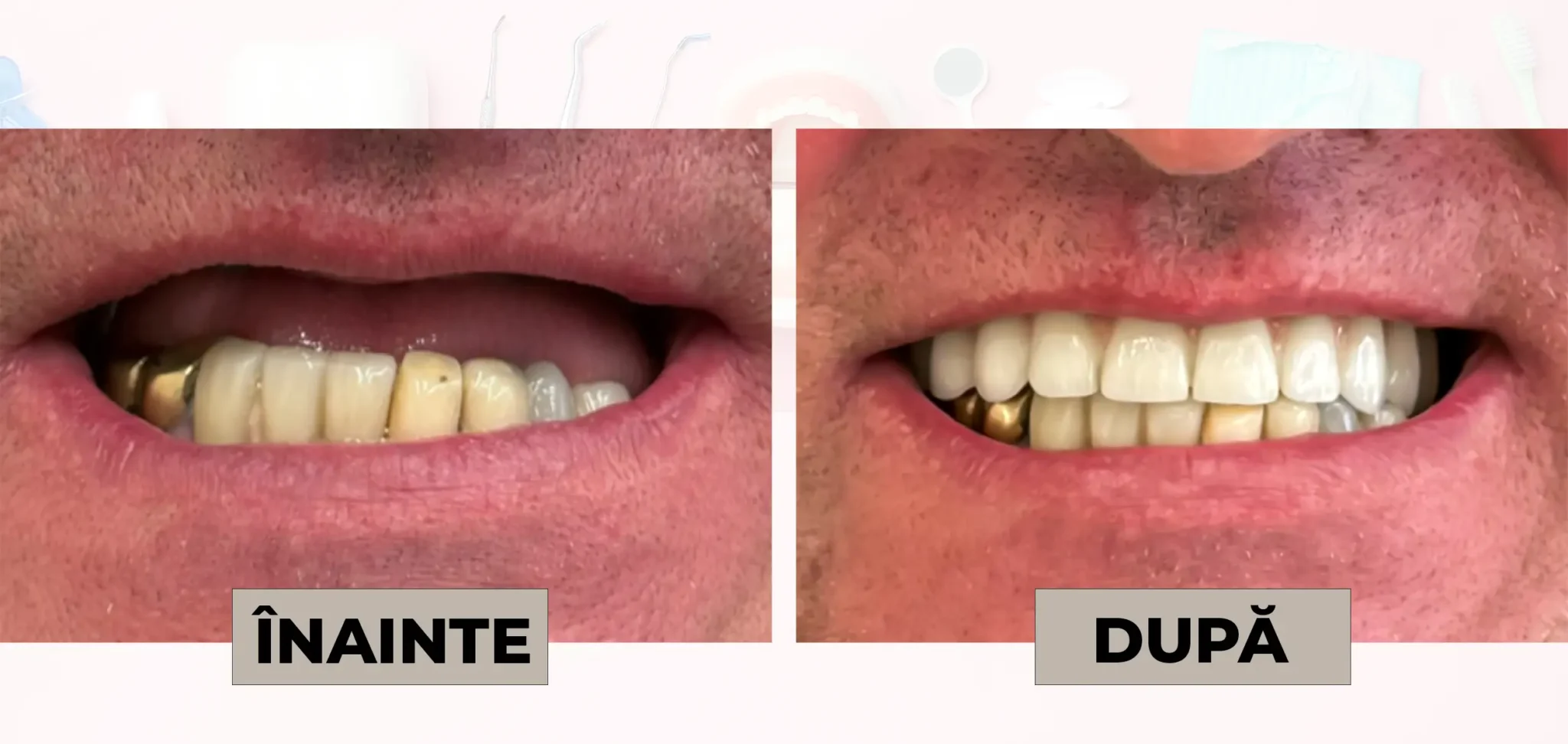 Cazuri_clinice_DrDehelean_037 - Clinica Stomatologica Dr Dehelean Bucuresti Before and after teeth whitening: left panel shows yellowed teeth, right panel shows brighter white teeth.