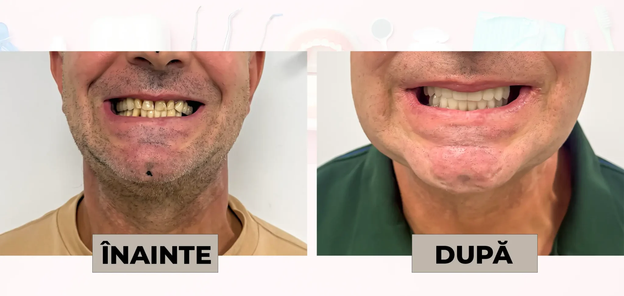 Cazuri_clinice_DrDehelean_038 - Clinica Stomatologica Dr Dehelean Bucuresti Two-panel image comparing a man's teeth: before (left) with yellowed teeth and uneven gums, after (right) with whiter, brighter teeth and a cleaner smile.