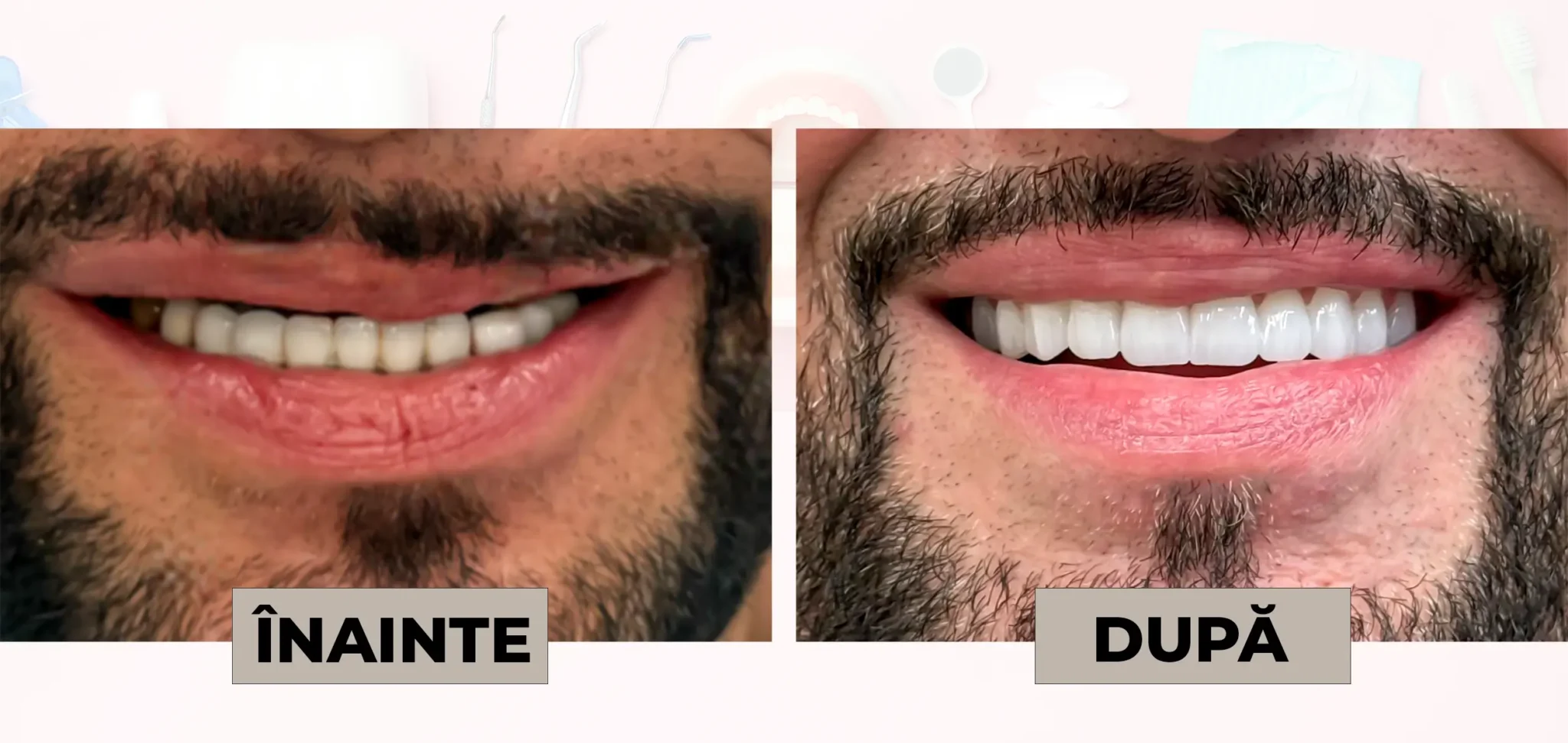 Cazuri_clinice_DrDehelean_039 - Clinica Stomatologica Dr Dehelean Bucuresti Before and after dental whitening: left image shows yellowed teeth labeled 'INAINTE' (before), right image shows bright white teeth labeled 'DUPĂ' (after).
