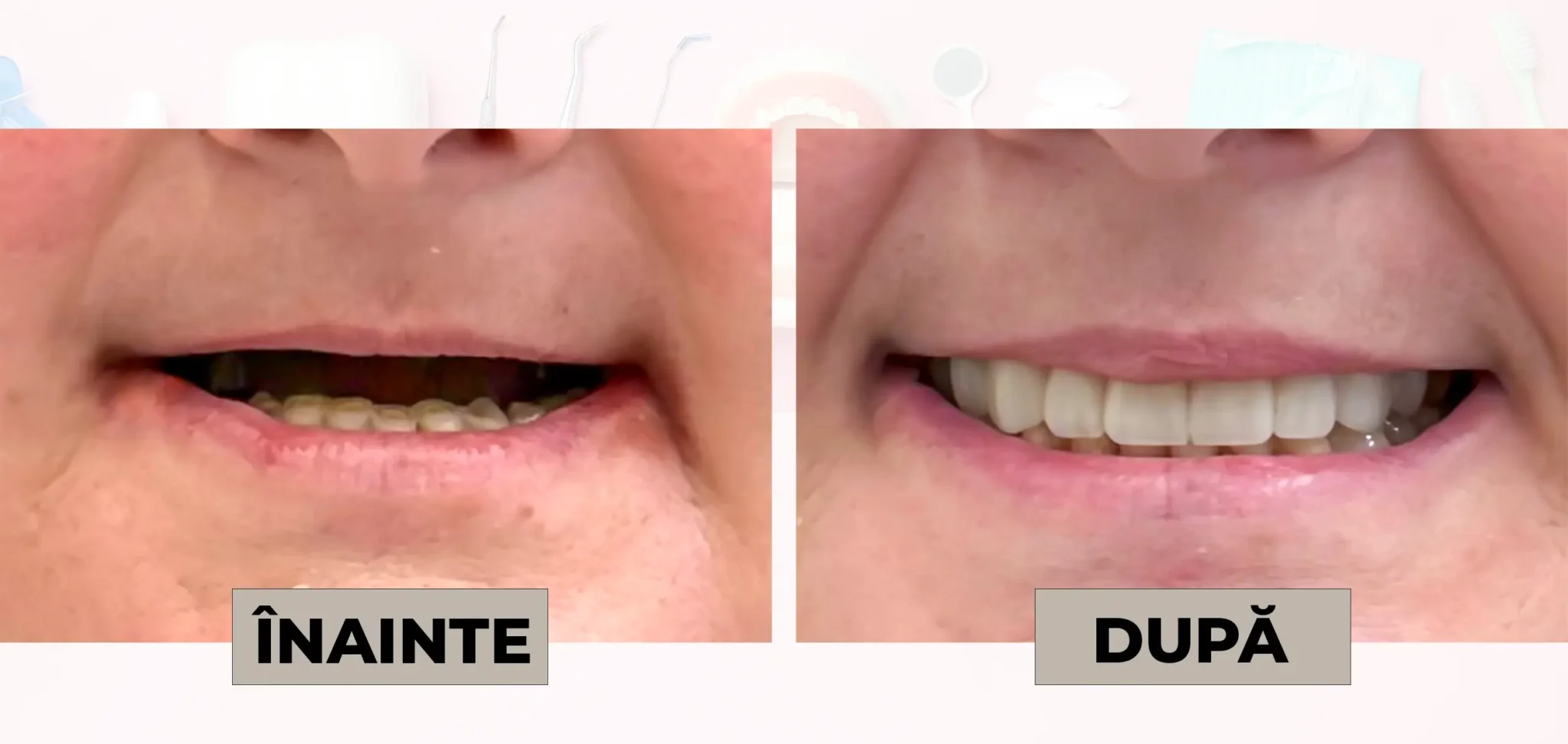 Cazuri_clinice_DrDehelean_047 - Clinica Stomatologica Dr Dehelean Bucuresti Split-screen before/after dental whitening: left side shows yellowed teeth, right side shows noticeably whiter teeth.