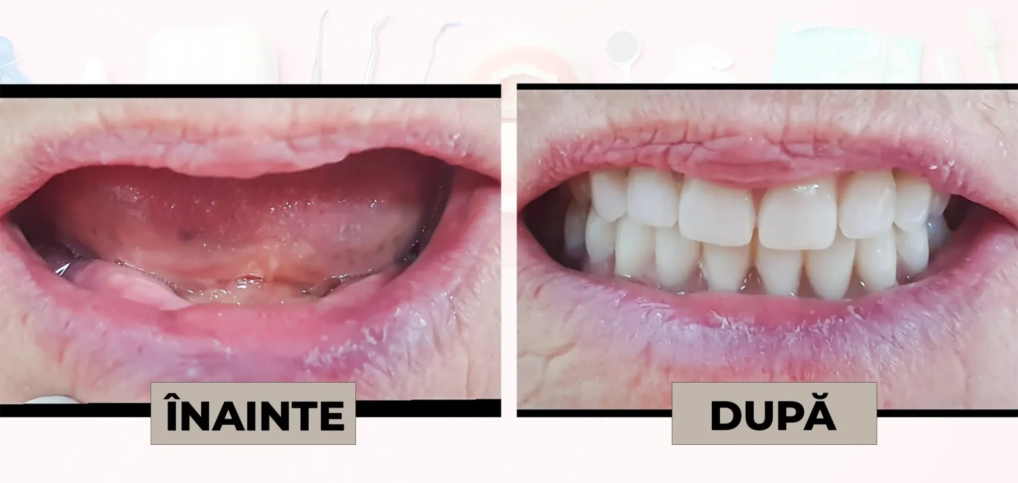 Cazuri_clinice_DrDehelean_048 - Clinica Stomatologica Dr Dehelean Bucuresti Side-by-side close-up of a mouth before and after dental treatment: the left image shows a missing lower tooth and darkened gum area, the right image shows a full set of white teeth after restoration (Before/After).