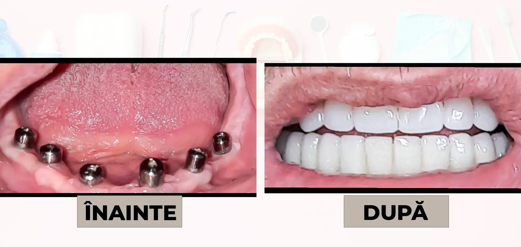Cazuri_clinice_DrDehelean_049 - Clinica Stomatologica Dr Dehelean Bucuresti Before and after dental implant treatment: left shows jaw with multiple implant caps, right shows a full dental prosthesis in the upper jaw (after).