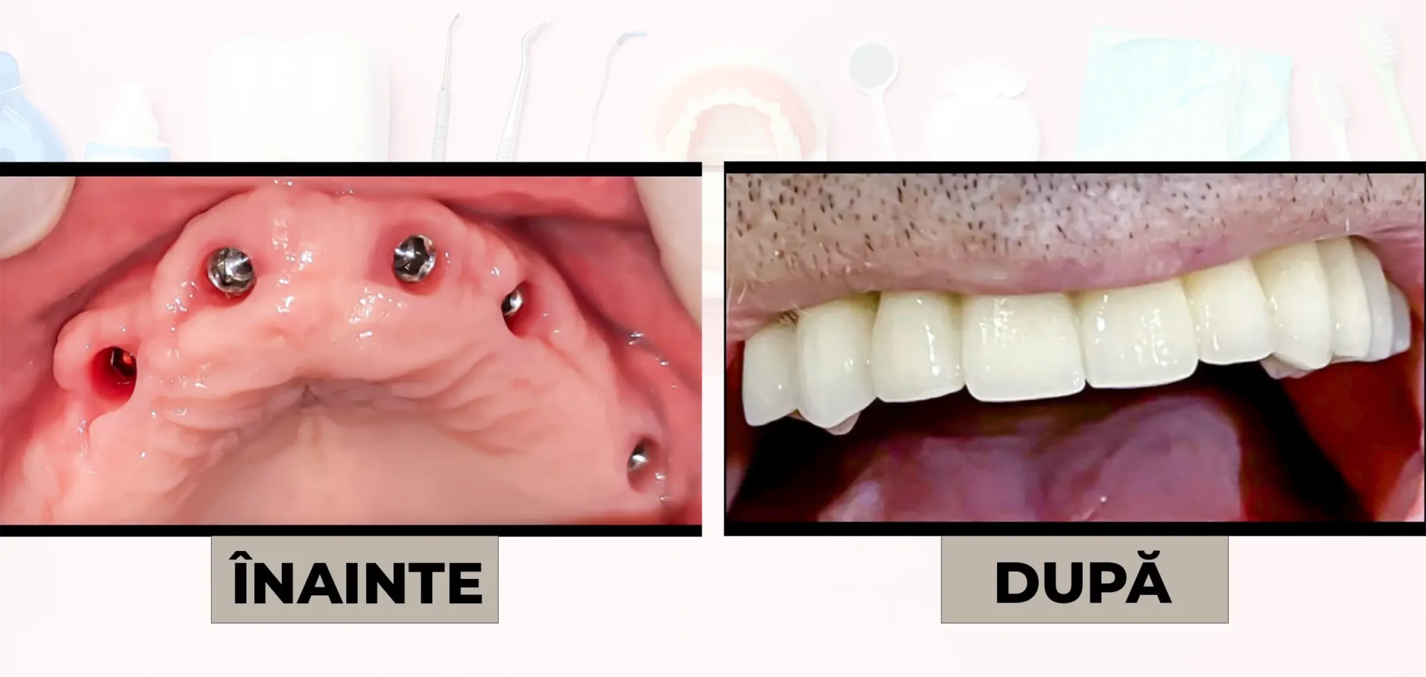 Cazuri_clinice_DrDehelean_050 - Clinica Stomatologica Dr Dehelean Bucuresti Before-and-after dental implant images: left shows upper jaw with three implants exposed, right shows restored upper teeth with implants in place