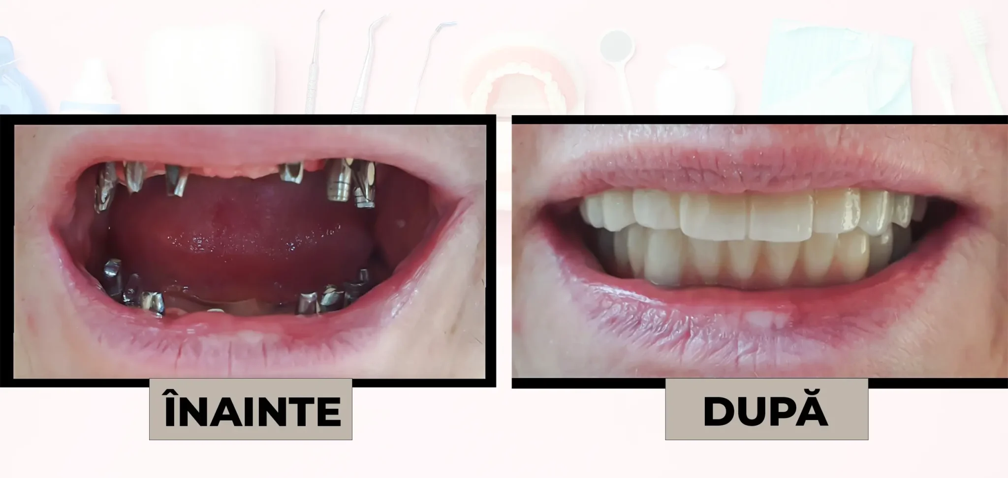 Cazuri_clinice_DrDehelean_051 - Clinica Stomatologica Dr Dehelean Bucuresti Before-and-after dental implant restoration: left image shows teeth missing with multiple implants; right image shows a full set of upper teeth after treatment.