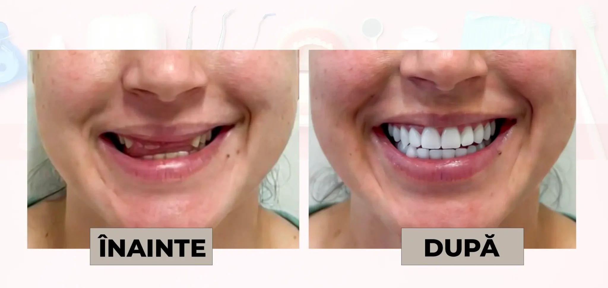 Cazuri_clinice_DrDehelean_052 - Clinica Stomatologica Dr Dehelean Bucuresti Two-panel photo showing a smile before and after dental treatment: left with missing teeth and gaps, right with a full set of straight, white teeth.