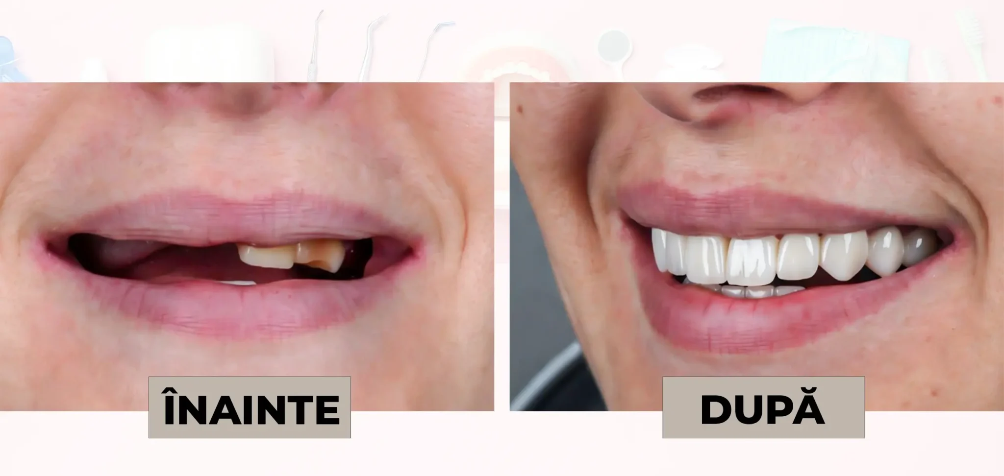Cazuri_clinice_DrDehelean_057 - Clinica Stomatologica Dr Dehelean Bucuresti